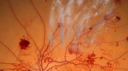 Diabetic Retinopathy