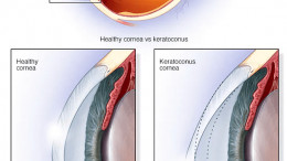 Keratoconus