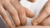 Acupuncture