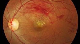 Retinal Occulsions