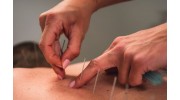 Acupuncture Services